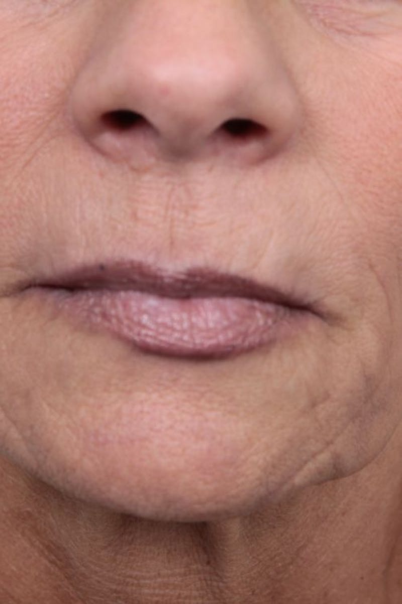 Facelift | Neck Lift Before & After Gallery - Patient 115097 - Image 7 - Scott Chapin, MD