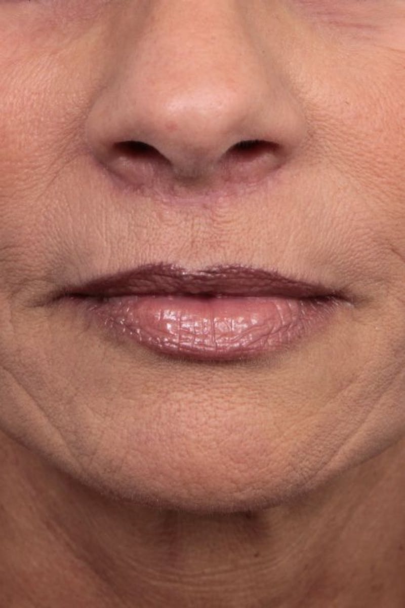 Facelift | Neck Lift Before & After Gallery - Patient 115097 - Image 8 - Scott Chapin, MD