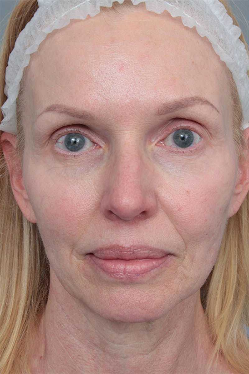 Facelift | Neck Lift Before & After Gallery - Patient 334966 - Image 3 - Scott Chapin, MD