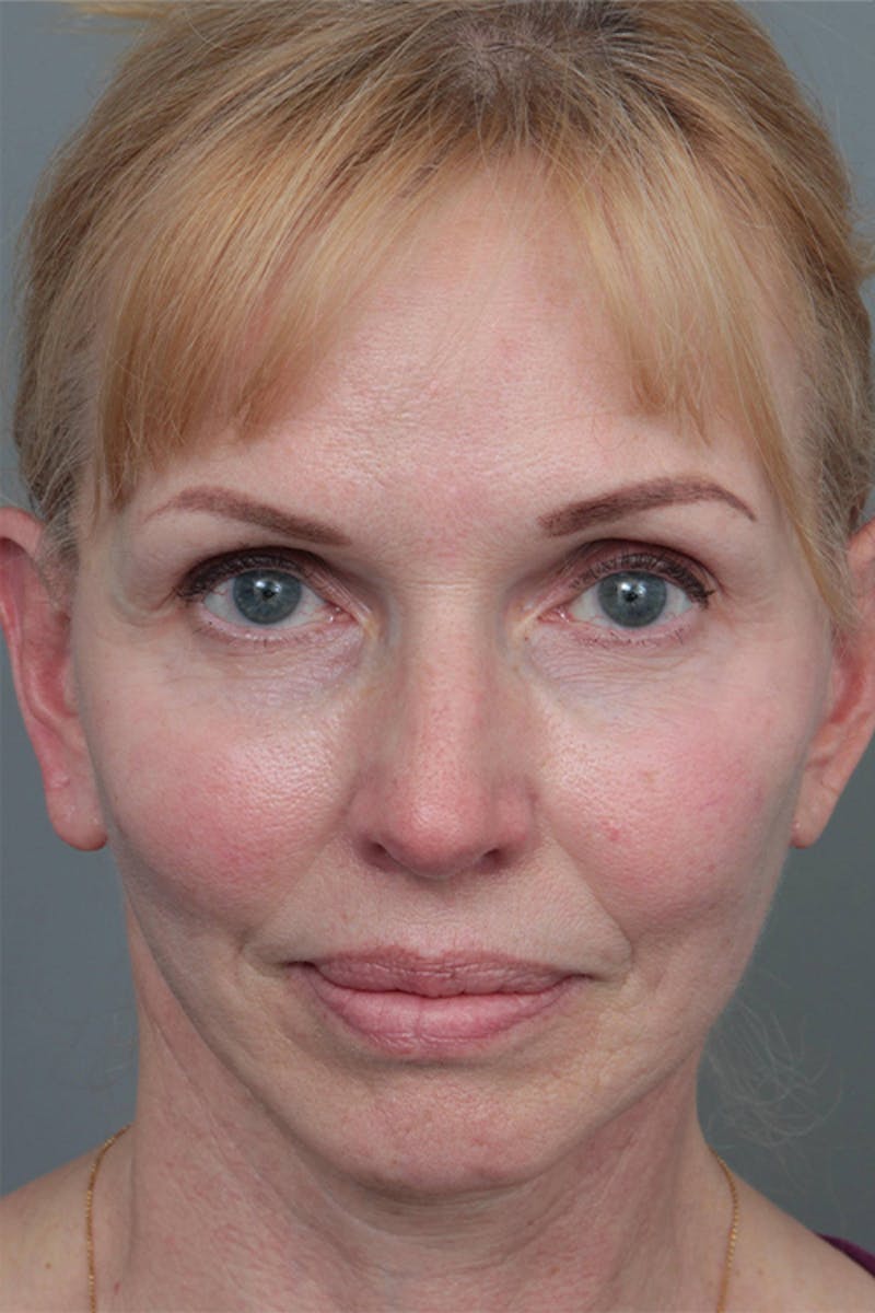 Facelift | Neck Lift Before & After Gallery - Patient 334966 - Image 4 - Scott Chapin, MD