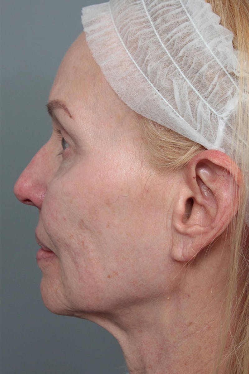 Facelift | Neck Lift Before & After Gallery - Patient 334966 - Image 7 - Scott Chapin, MD