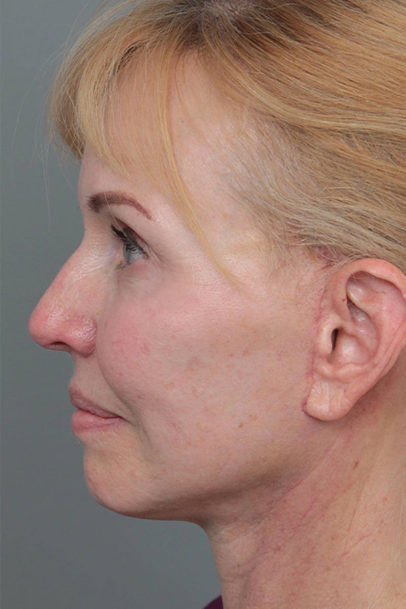 Facelift | Neck Lift Before & After Gallery - Patient 334966 - Image 8 - Scott Chapin, MD
