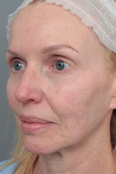 Facelift | Neck Lift Before & After Gallery - Patient 334966 - Image 1 - Scott Chapin, MD