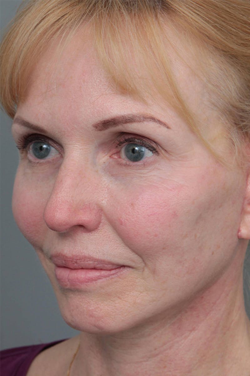 Facelift | Neck Lift Before & After Gallery - Patient 334966 - Image 2 - Scott Chapin, MD