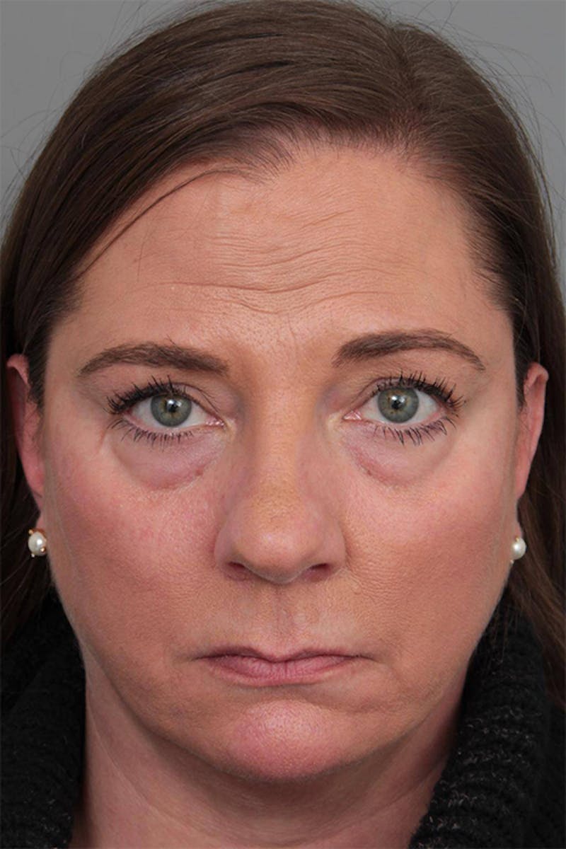 Facelift | Neck Lift Before & After Gallery - Patient 399353 - Image 3 - Scott Chapin, MD