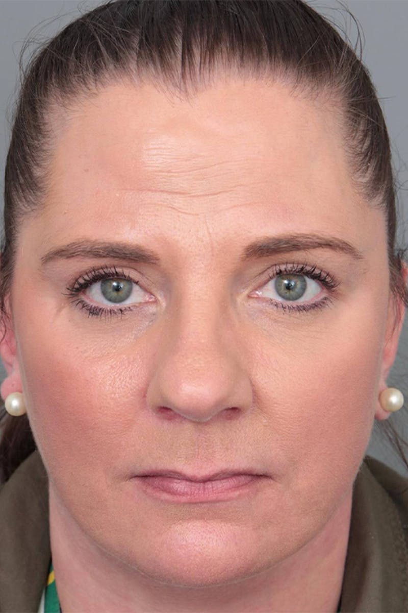 Facelift | Neck Lift Before & After Gallery - Patient 399353 - Image 4 - Scott Chapin, MD