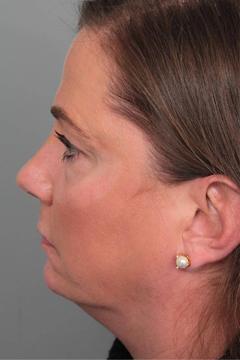 Facelift | Neck Lift Before & After Gallery - Patient 399353 - Image 5 - Scott Chapin, MD