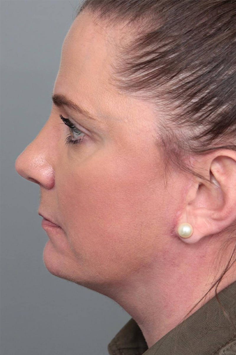 Facelift | Neck Lift Before & After Gallery - Patient 399353 - Image 6 - Scott Chapin, MD