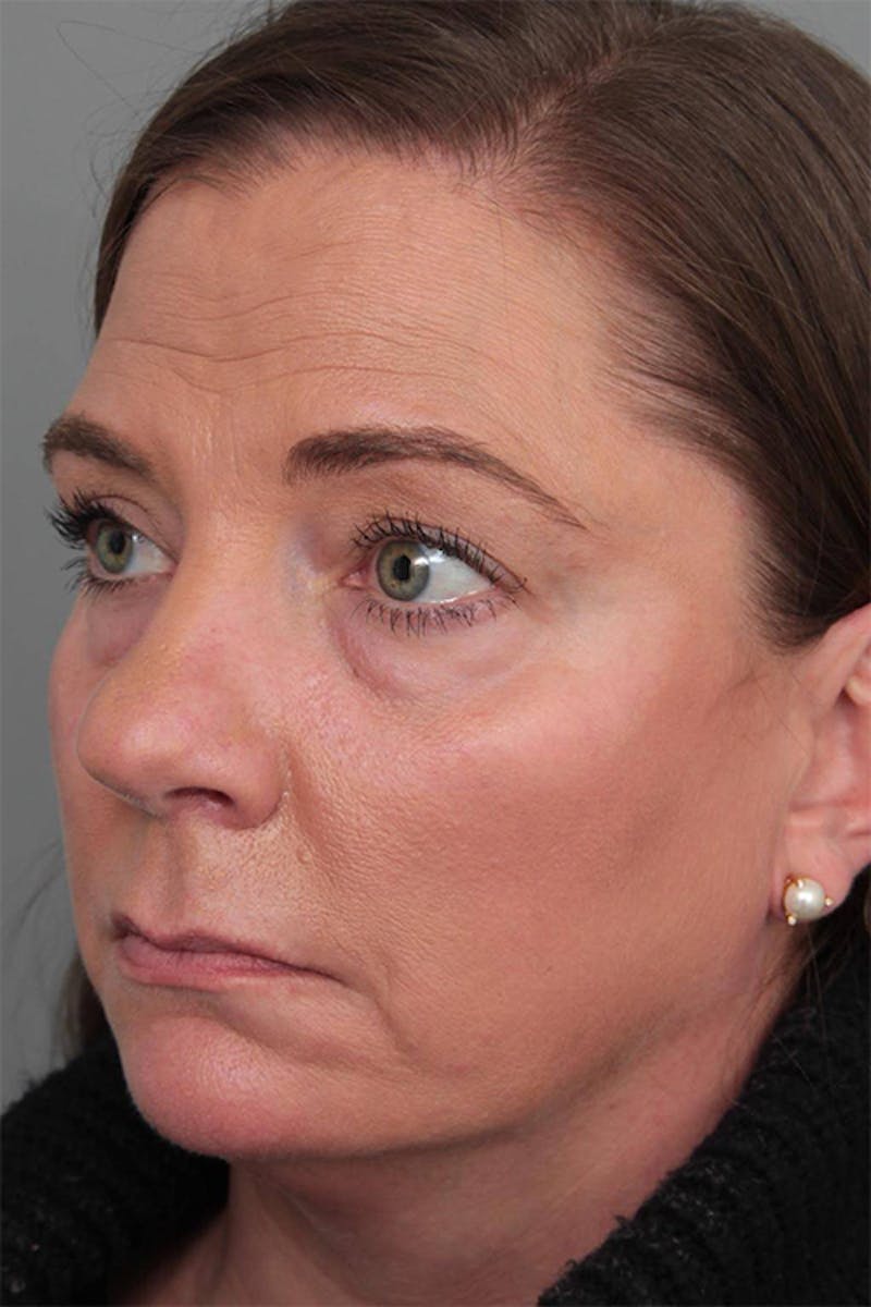 Facelift | Neck Lift Before & After Gallery - Patient 399353 - Image 1 - Scott Chapin, MD