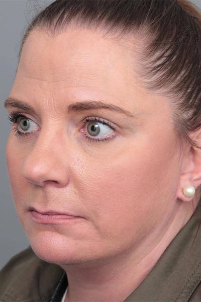Facelift | Neck Lift Before & After Gallery - Patient 399353 - Image 2 - Scott Chapin, MD