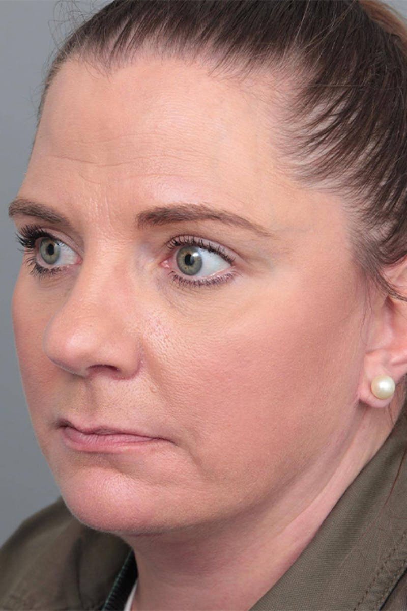 Facelift | Neck Lift Before & After Gallery - Patient 399353 - Image 2 - Scott Chapin, MD