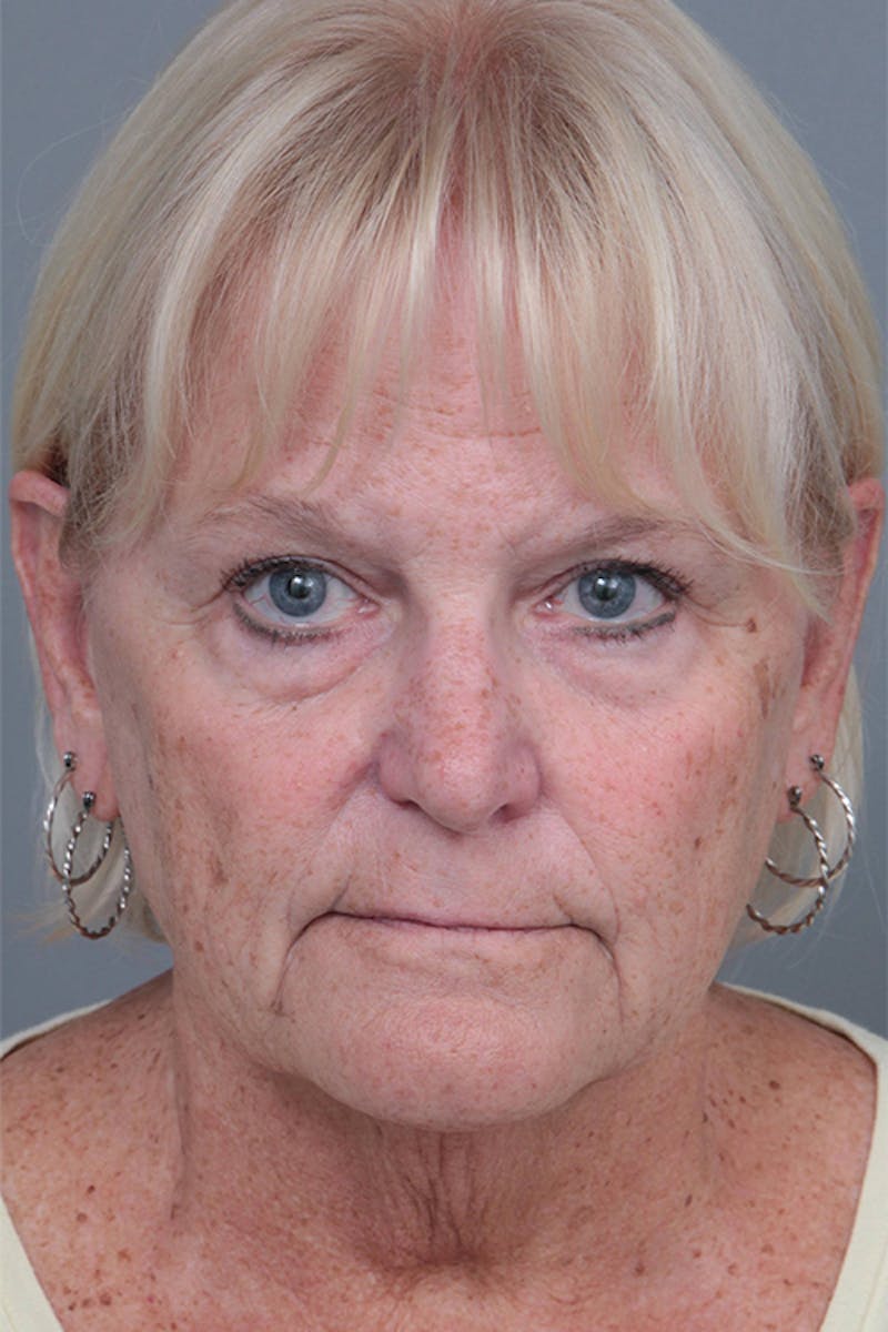 Facelift | Neck Lift Before & After Gallery - Patient 349003 - Image 3 - Scott Chapin, MD