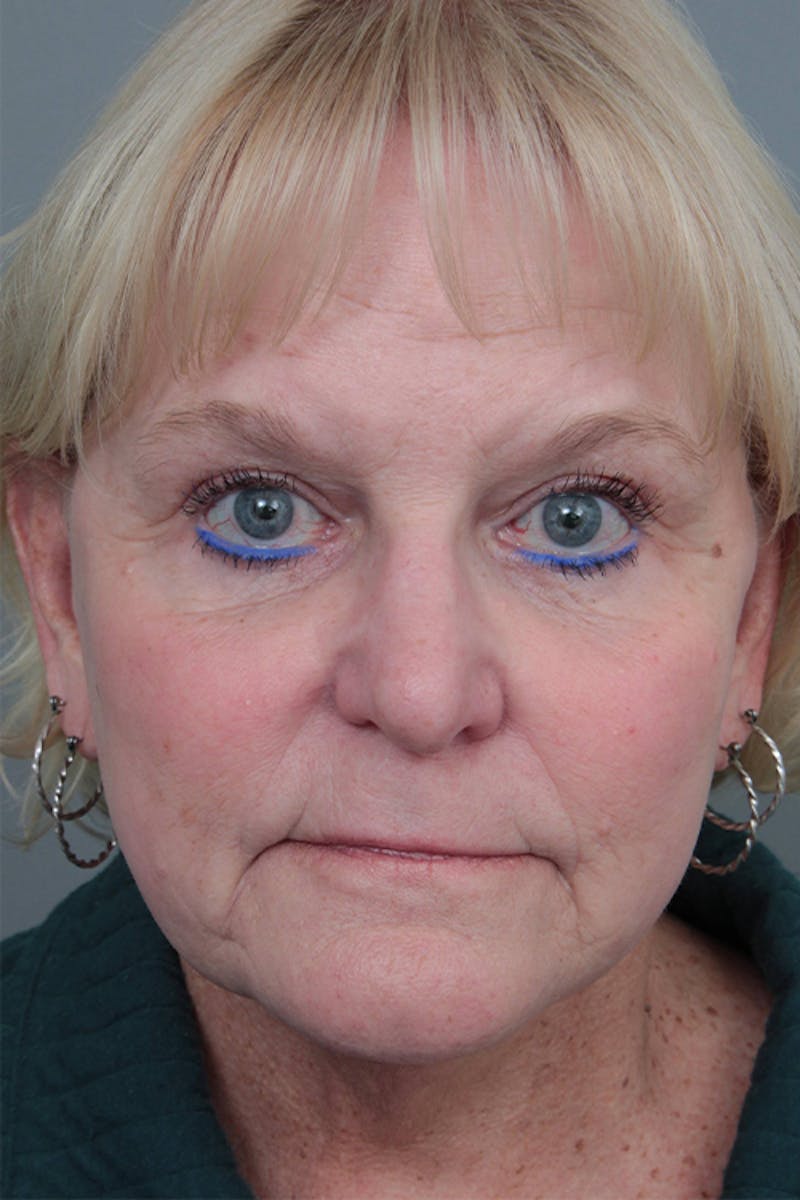 Facelift | Neck Lift Before & After Gallery - Patient 349003 - Image 4 - Scott Chapin, MD