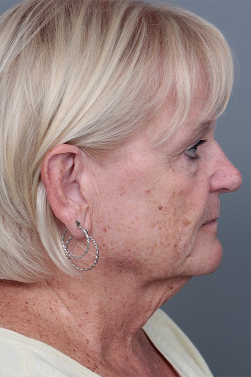Facelift | Neck Lift Before & After Gallery - Patient 349003 - Image 7 - Scott Chapin, MD