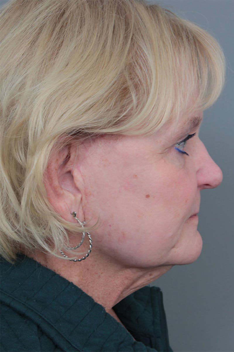 Facelift | Neck Lift Before & After Gallery - Patient 349003 - Image 8 - Scott Chapin, MD