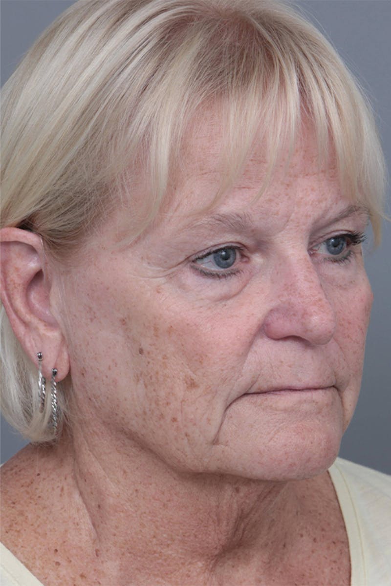 Facelift | Neck Lift Before & After Gallery - Patient 349003 - Image 1 - Scott Chapin, MD