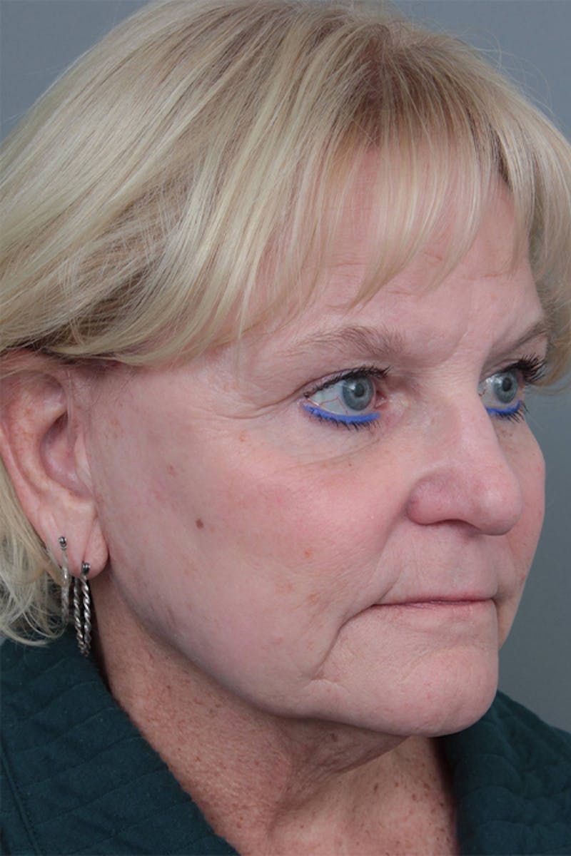 Facelift | Neck Lift Before & After Gallery - Patient 349003 - Image 2 - Scott Chapin, MD
