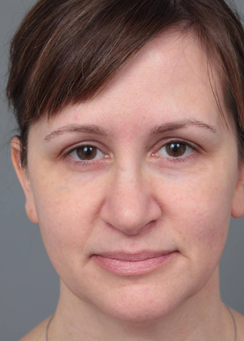 Facelift | Neck Lift Before & After Gallery - Patient 156825 - Image 3 - Scott Chapin, MD