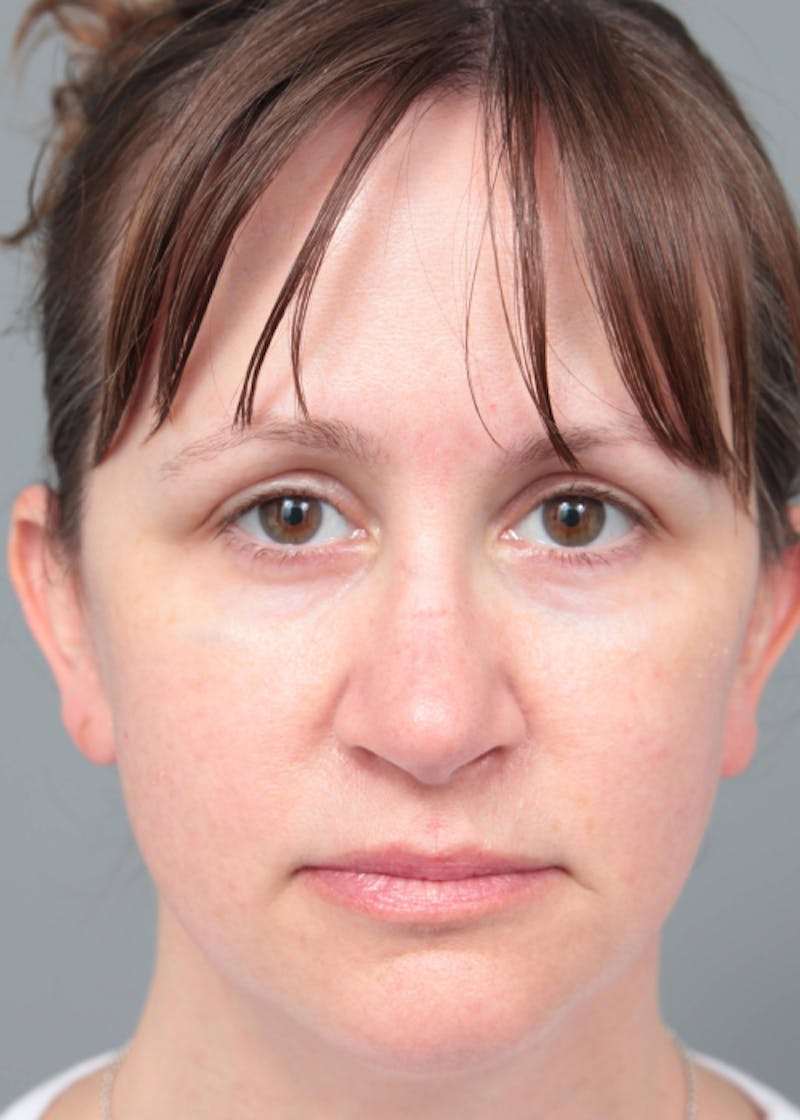 Facelift | Neck Lift Before & After Gallery - Patient 156825 - Image 4 - Scott Chapin, MD