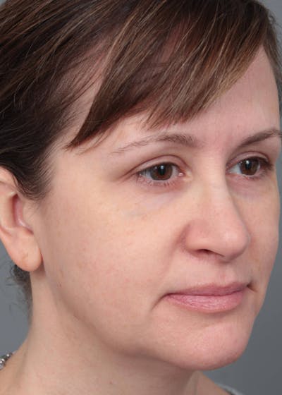 Facelift | Neck Lift Before & After Gallery - Patient 156825 - Image 1 - Scott Chapin, MD