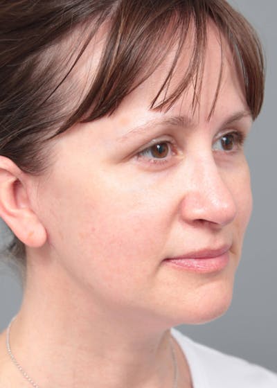 Facelift | Neck Lift Before & After Gallery - Patient 156825 - Image 2 - Scott Chapin, MD