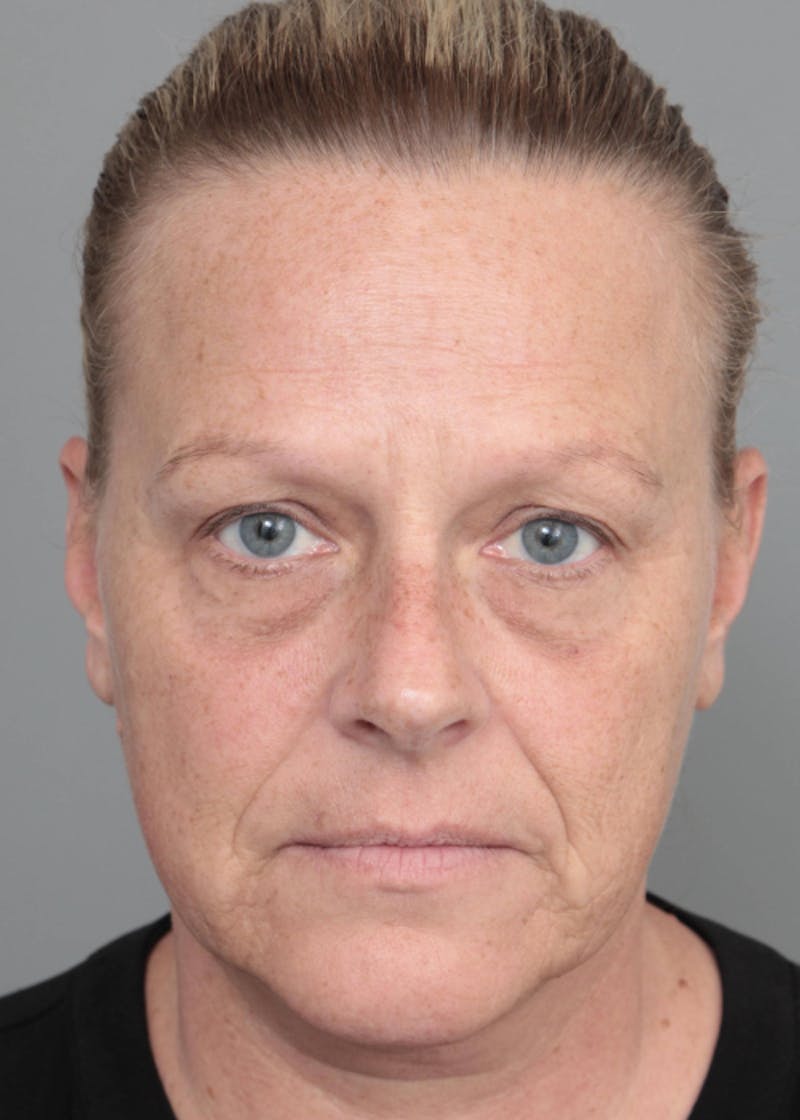 Facelift | Neck Lift Before & After Gallery - Patient 398916 - Image 3 - Scott Chapin, MD