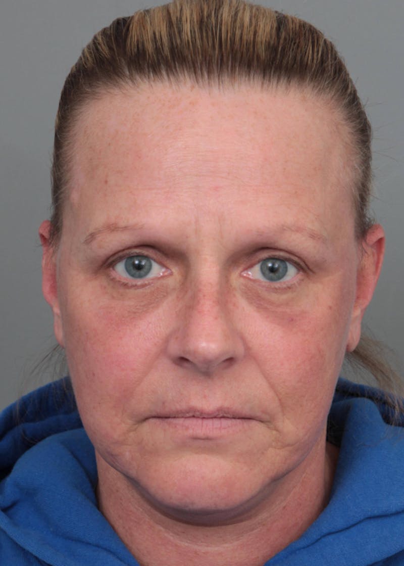 Facelift | Neck Lift Before & After Gallery - Patient 398916 - Image 4 - Scott Chapin, MD