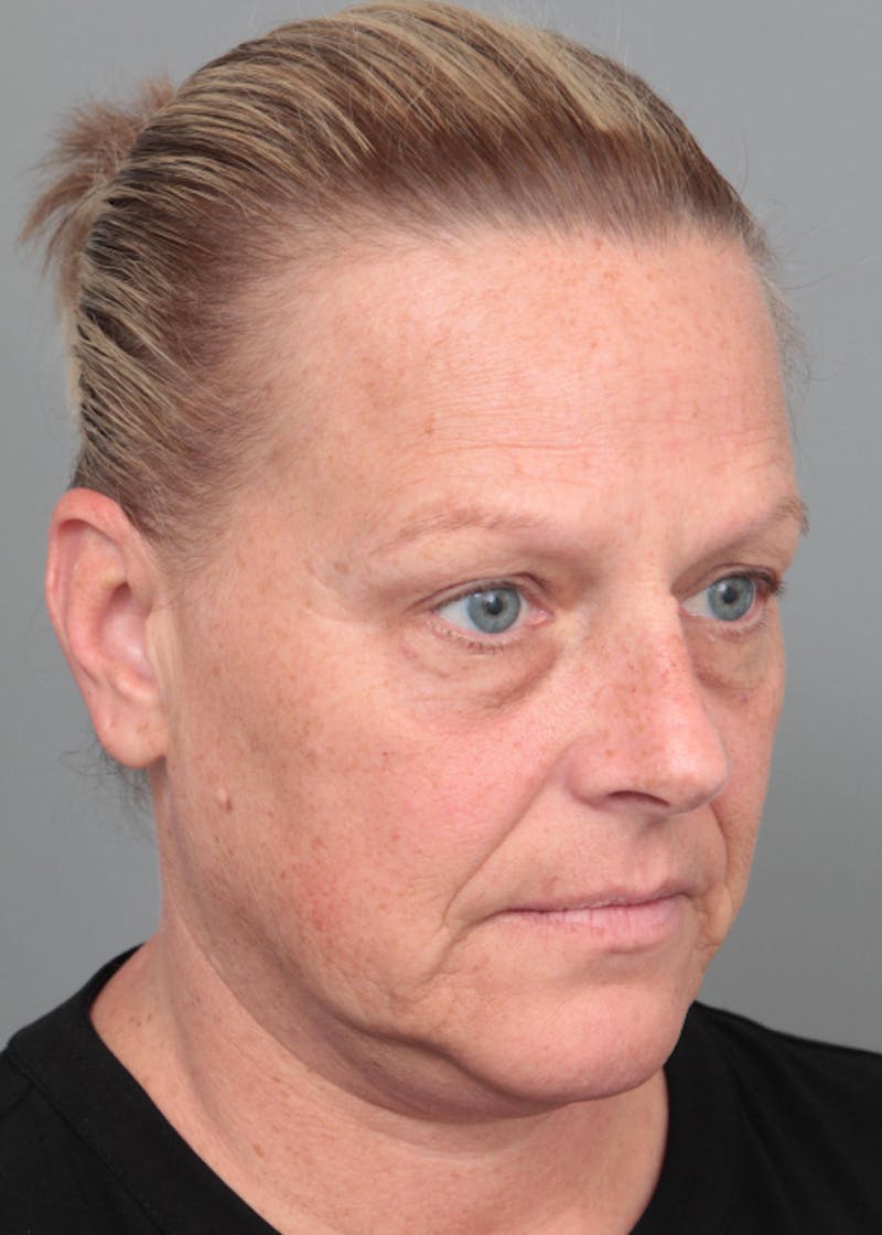 Facelift | Neck Lift Before & After Gallery - Patient 398916 - Image 1 - Scott Chapin, MD