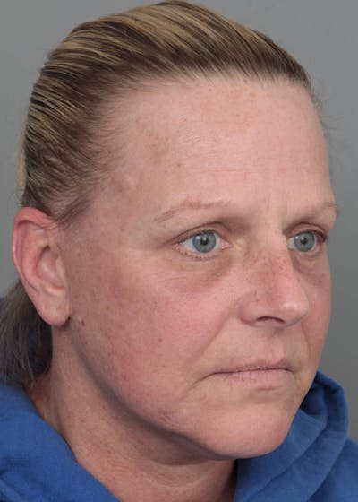 Facelift | Neck Lift Before & After Gallery - Patient 398916 - Image 2 - Scott Chapin, MD