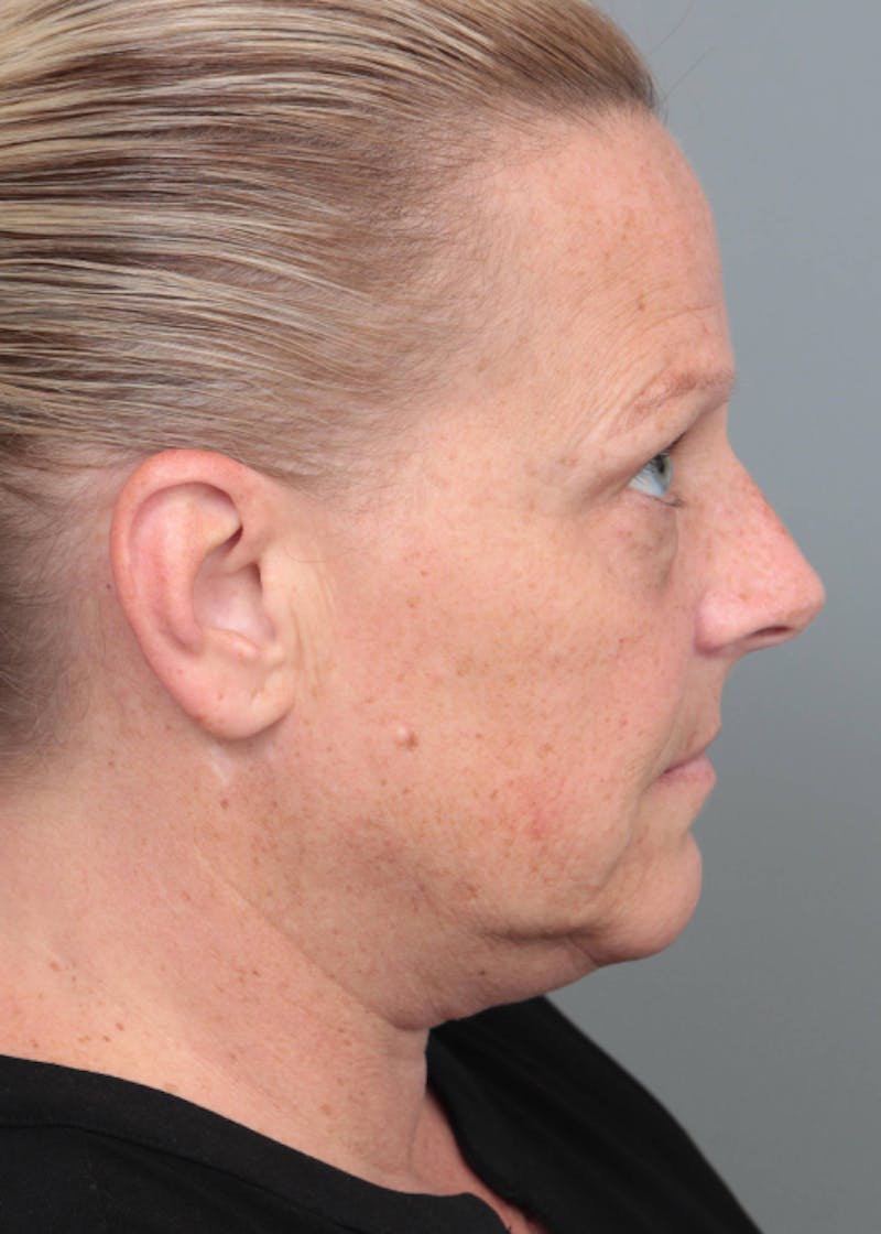 Facelift | Neck Lift Before & After Gallery - Patient 398916 - Image 5 - Scott Chapin, MD