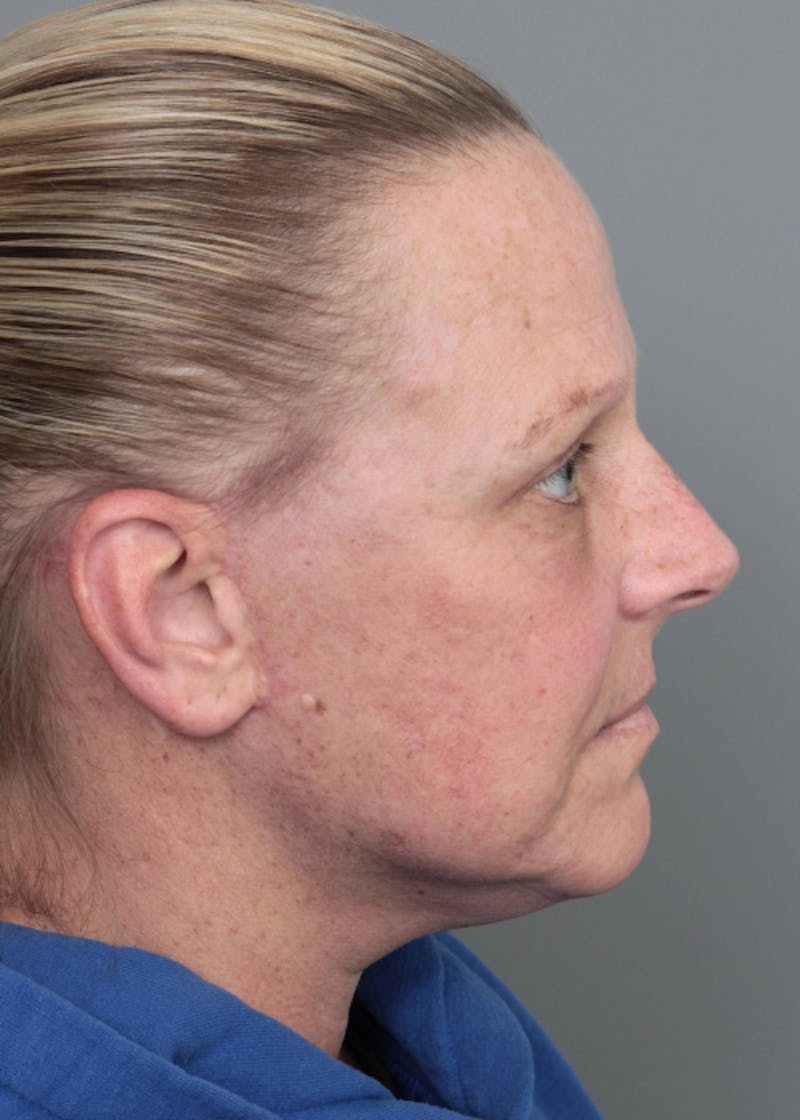 Facelift | Neck Lift Before & After Gallery - Patient 398916 - Image 6 - Scott Chapin, MD