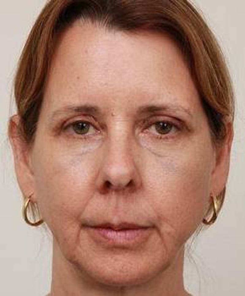 Facelift | Neck Lift Before & After Gallery - Patient 260271 - Image 3 - Scott Chapin, MD