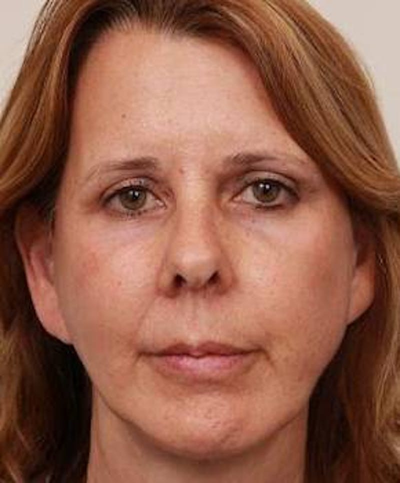 Facelift | Neck Lift Before & After Gallery - Patient 260271 - Image 4 - Scott Chapin, MD