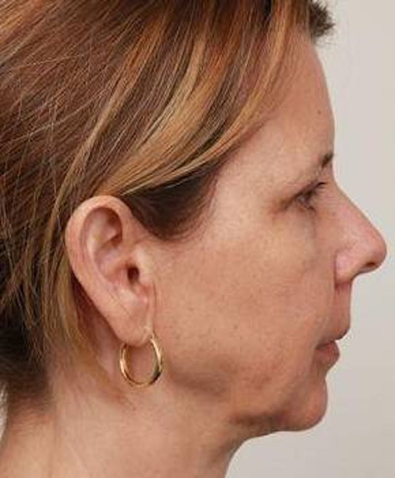 Facelift | Neck Lift Before & After Gallery - Patient 260271 - Image 5 - Scott Chapin, MD