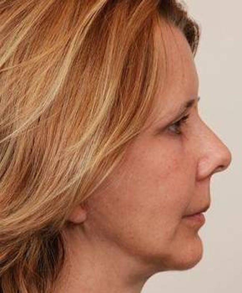 Facelift | Neck Lift Before & After Gallery - Patient 260271 - Image 6 - Scott Chapin, MD