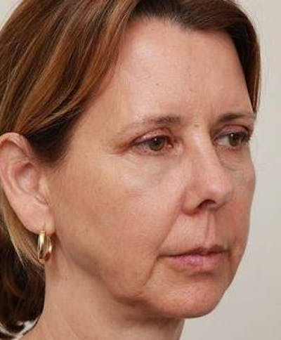 Facelift | Neck Lift Before & After Gallery - Patient 260271 - Image 1 - Scott Chapin, MD