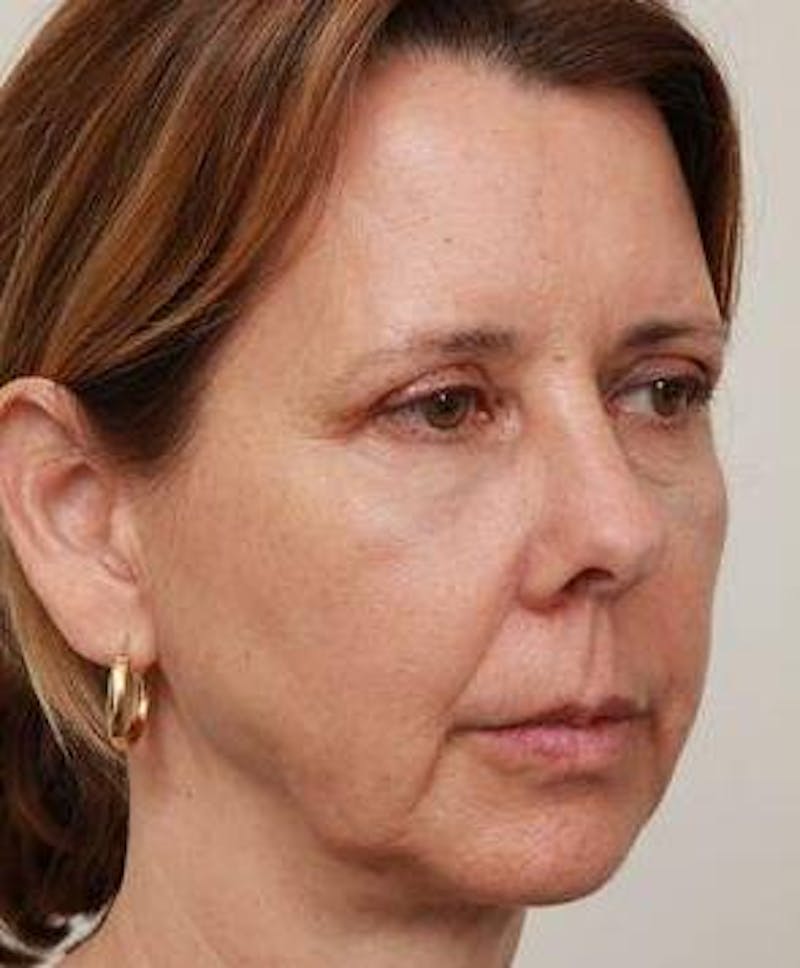 Facelift | Neck Lift Before & After Gallery - Patient 260271 - Image 1 - Scott Chapin, MD