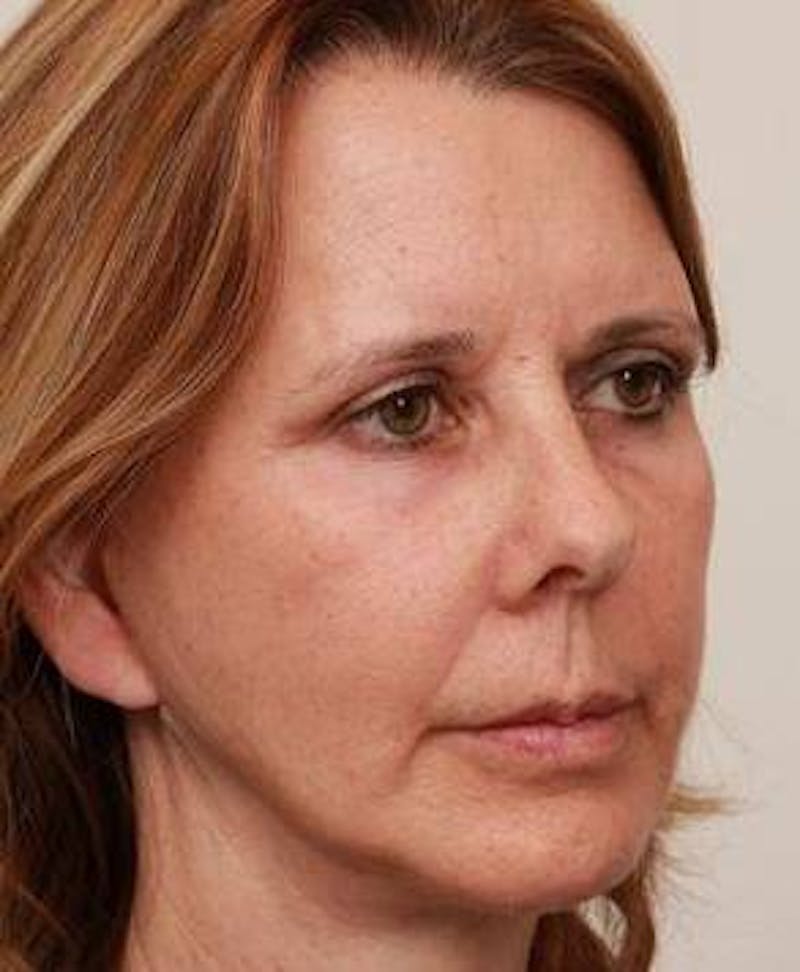 Facelift | Neck Lift Before & After Gallery - Patient 260271 - Image 2 - Scott Chapin, MD
