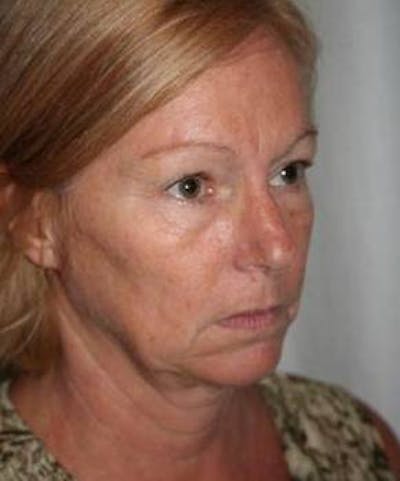 Facelift | Neck Lift Before & After Gallery - Patient 251365 - Image 1 - Scott Chapin, MD