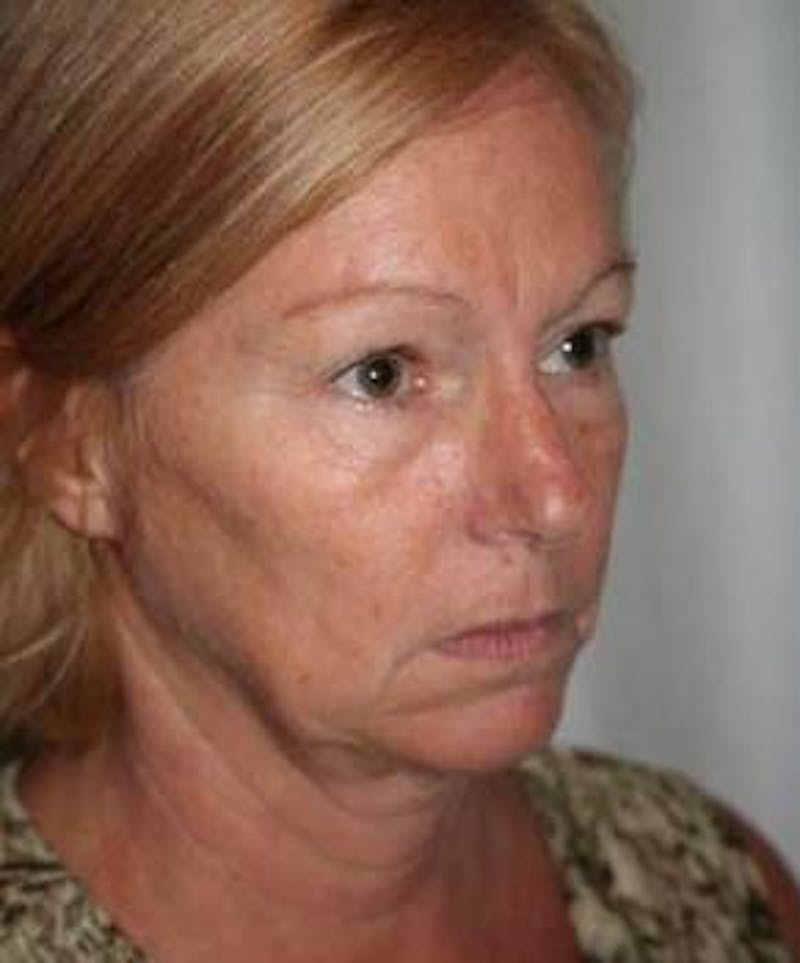 Facelift | Neck Lift Before & After Gallery - Patient 251365 - Image 1 - Scott Chapin, MD