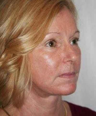 Facelift | Neck Lift Before & After Gallery - Patient 251365 - Image 2 - Scott Chapin, MD
