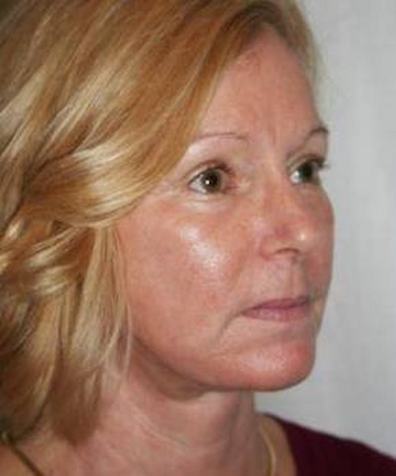 Facelift | Neck Lift Before & After Gallery - Patient 251365 - Image 2 - Scott Chapin, MD