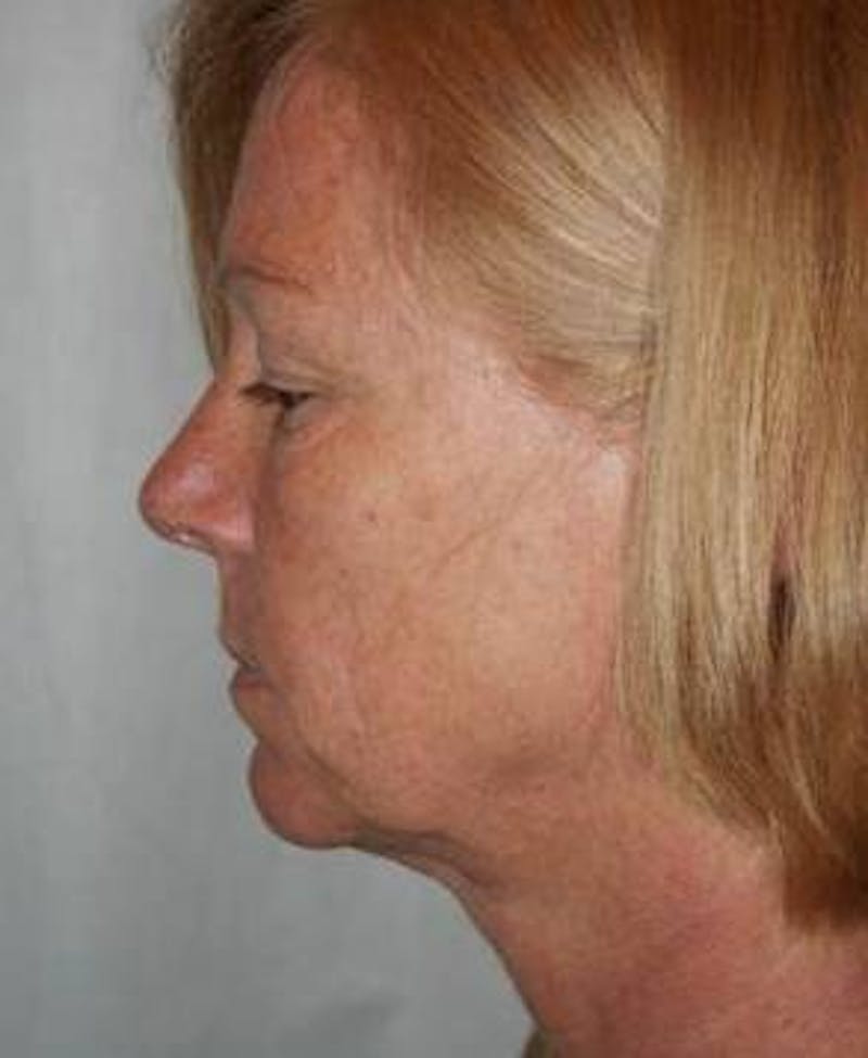 Facelift | Neck Lift Before & After Gallery - Patient 251365 - Image 3 - Scott Chapin, MD