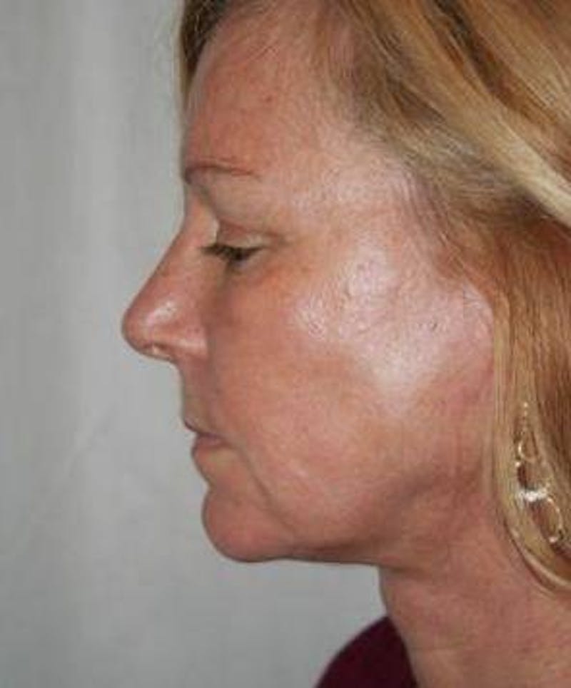 Facelift | Neck Lift Before & After Gallery - Patient 251365 - Image 4 - Scott Chapin, MD