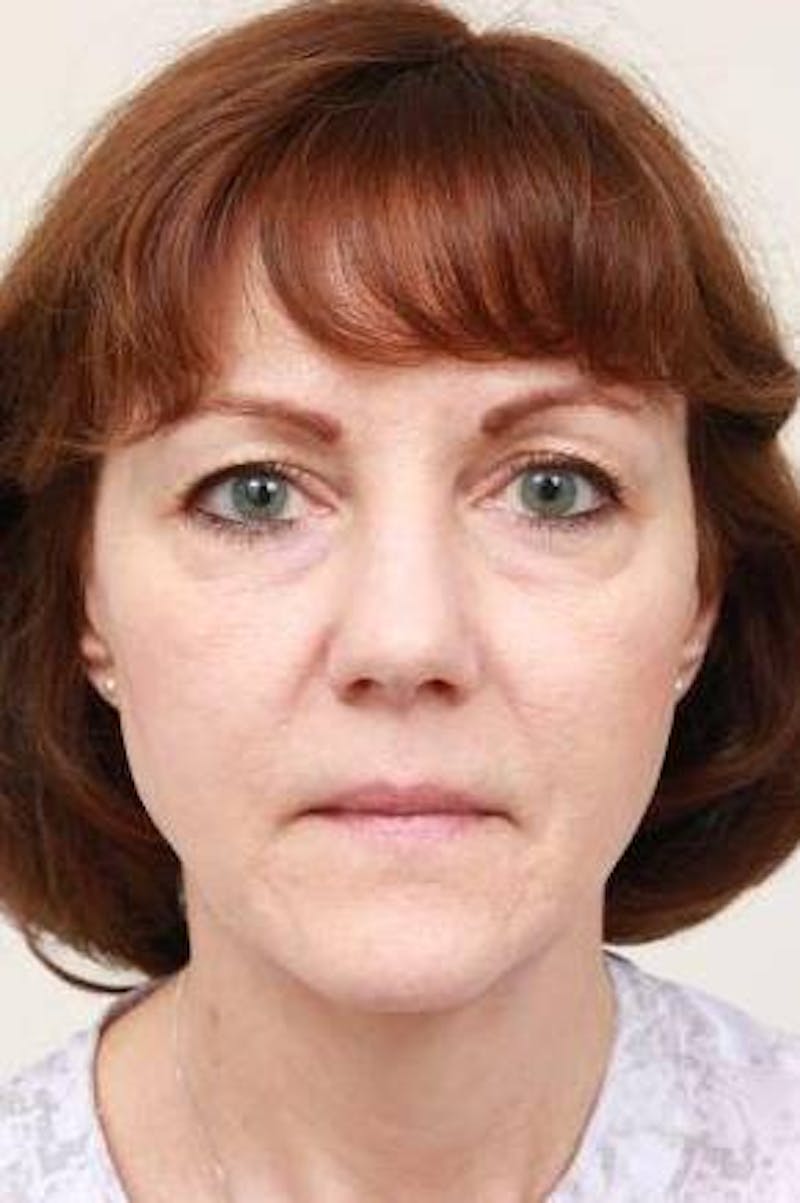Facelift | Neck Lift Before & After Gallery - Patient 331200 - Image 3 - Scott Chapin, MD
