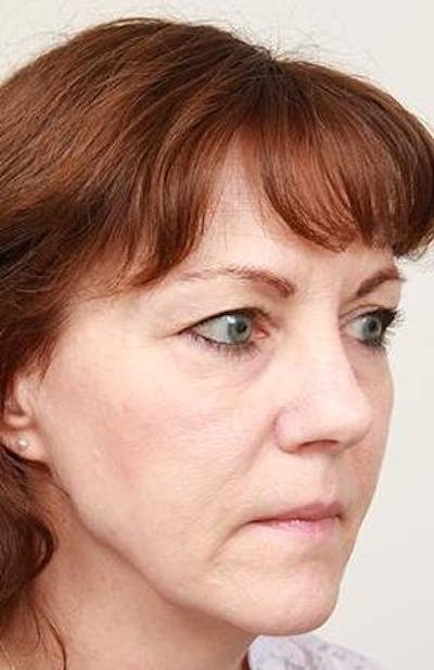 Facelift | Neck Lift Before & After Gallery - Patient 331200 - Image 1 - Scott Chapin, MD