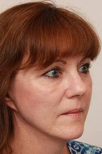 Facelift | Neck Lift Before & After Gallery - Patient 331200 - Image 2 - Scott Chapin, MD