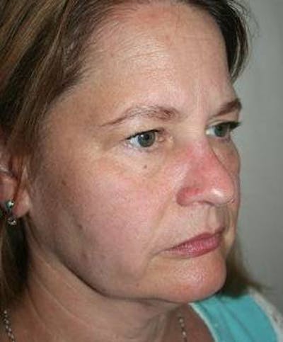 Facelift | Neck Lift Before & After Gallery - Patient 350605 - Image 1 - Scott Chapin, MD