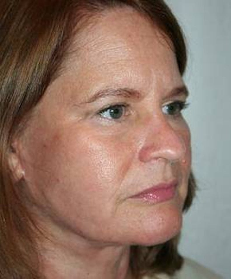 Facelift | Neck Lift Before & After Gallery - Patient 350605 - Image 2 - Scott Chapin, MD