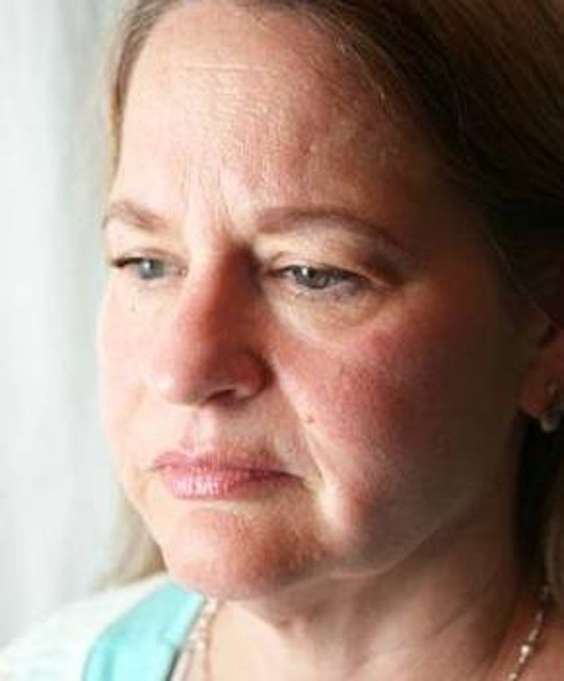 Facelift | Neck Lift Before & After Gallery - Patient 350605 - Image 3 - Scott Chapin, MD